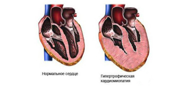 гипертрофическая кардиомиопатия фото